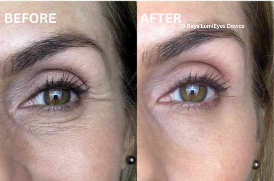 LumiEyes Under-Eye Red Light Therapy