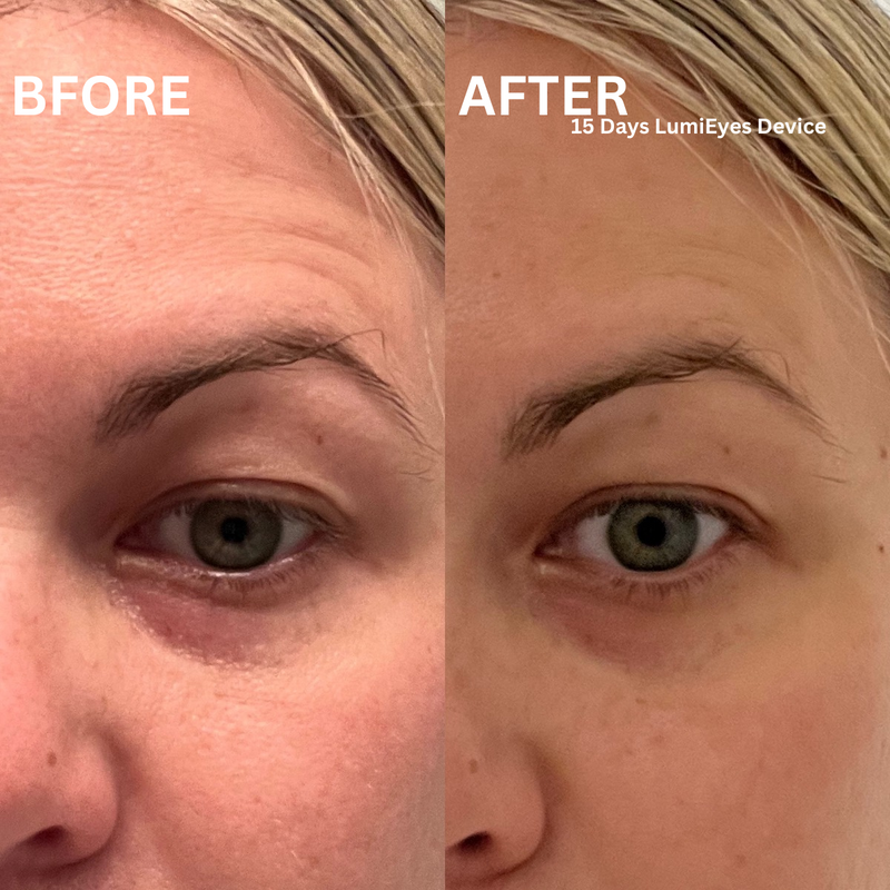 LumiEyes Under-Eye Red Light Therapy
