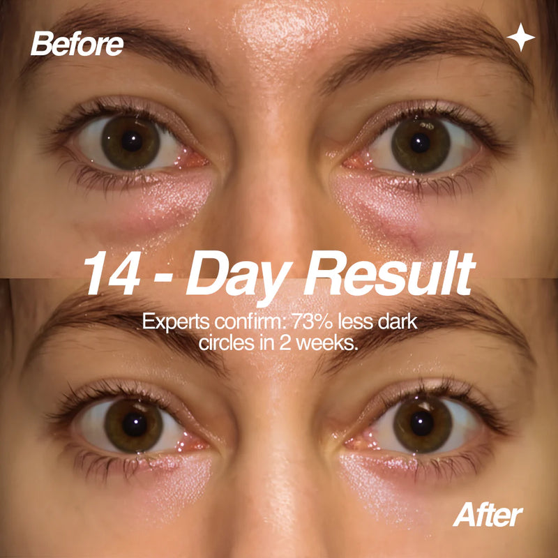 LumiEyes Under-Eye Red Light Therapy