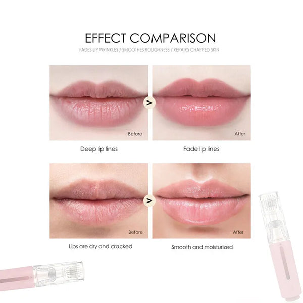 LipNeedleX